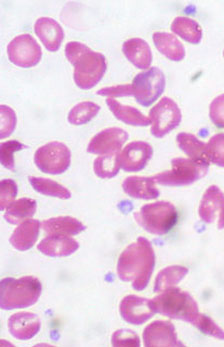 $4 million funds study of sickle cell disease in teens, adults